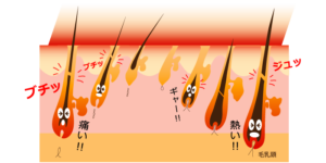ハイパースキン脱毛