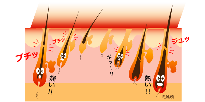 ハイパースキン脱毛