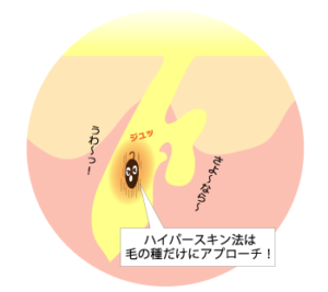 ハイパースキン脱毛法