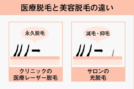 医療脱毛と美容脱毛の違い｜ヒゲ脱毛はどちらがおすすめ？
