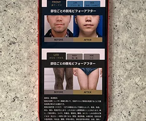 ゴリラクリニック名古屋栄院｜ヒゲ脱毛が最短8ヶ月で完了